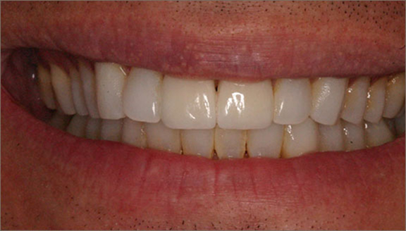 Teeth after treatment