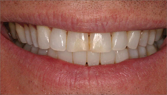 Teeth before treatment