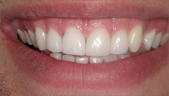 Smile with properly aligned teeth