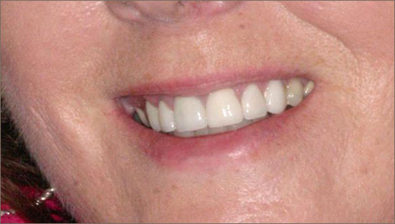 Close up of smile with brightened teeth