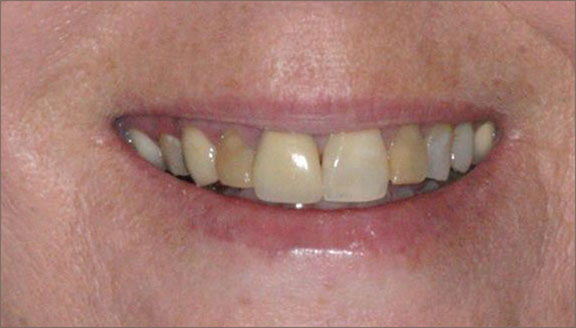 Close up of smile with discolored teeth