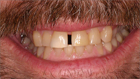 Close up of sizable gap between teeth