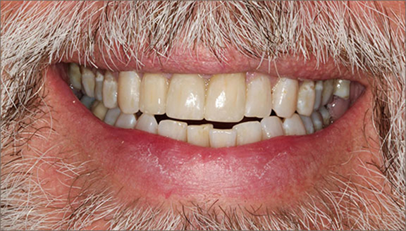 Close up of brightened and repaired teeth