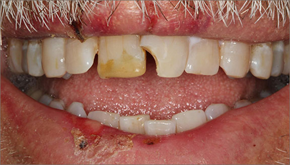 Close up of discolored and damaged teeth