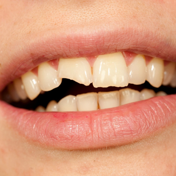 Up-close view of a chipped tooth