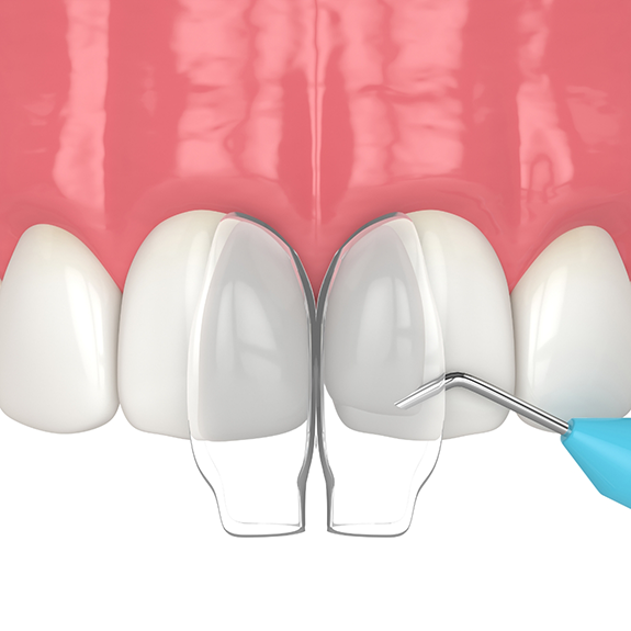 Illustration of direct bonding being performed on upper teeth