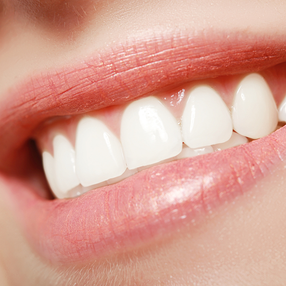 Close up of teeth after smile makeover