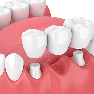 Illustration of dental bridge being attached to prepared teeth