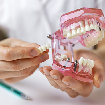 Close up of hands holding bridge and model of mouth with dental implants