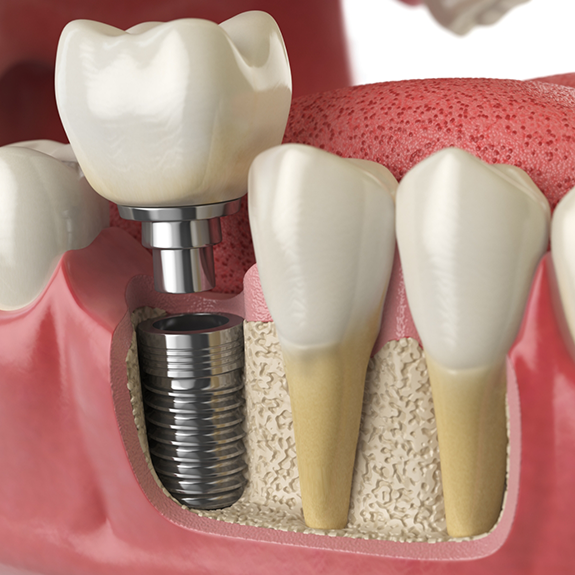 Illustration of crown being attached to dental implant