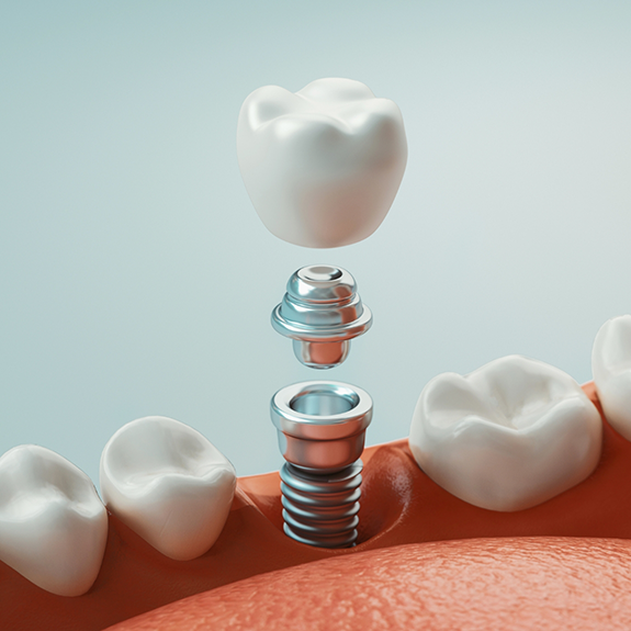 Illustration of crown abutment and dental implant in Reynoldsburg being inserted into jaw