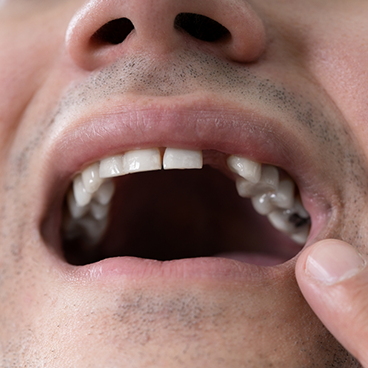 Man opening mouth to show missing tooth