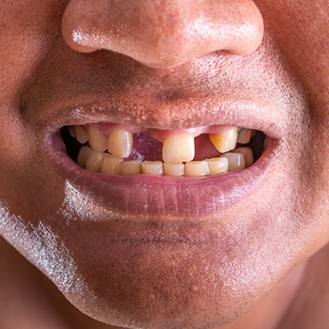 Close up of smile with multiple teeth missing