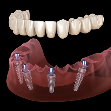 Illustration of full denture being attached to dental implants