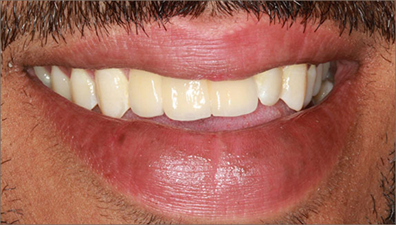 Close up of smile with front teeth replaced with dental implants