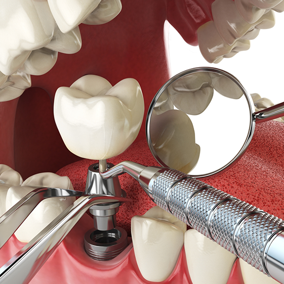 Illustration of dental crown being attached to implant post