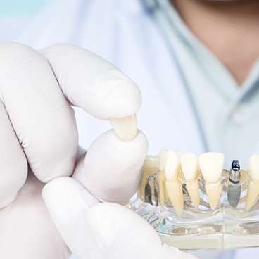 Close up of gloved hand holding crown and a dental implant model