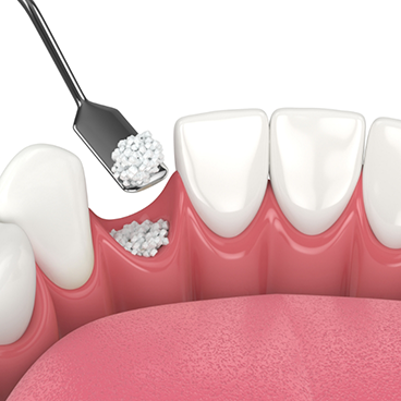 Illustration of bone grafting being applied to empty socket