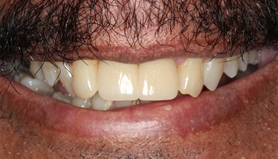 Close up of smile with multiple teeth replaced