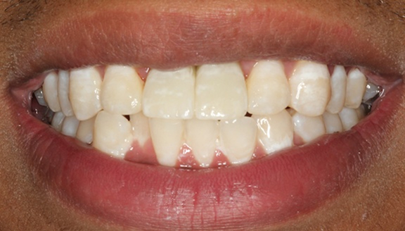 Close up of smile restored with dental implant