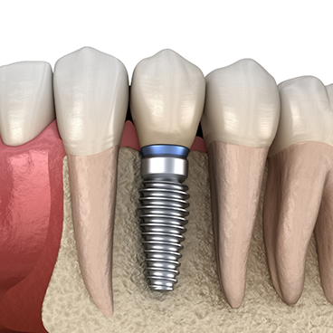 Illustration of dental implant inserted into jawbone