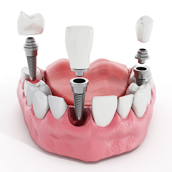 Illustration of multiple dental implants being placed in lower arch