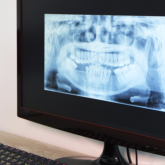 Digital X ray of teeth on monitor