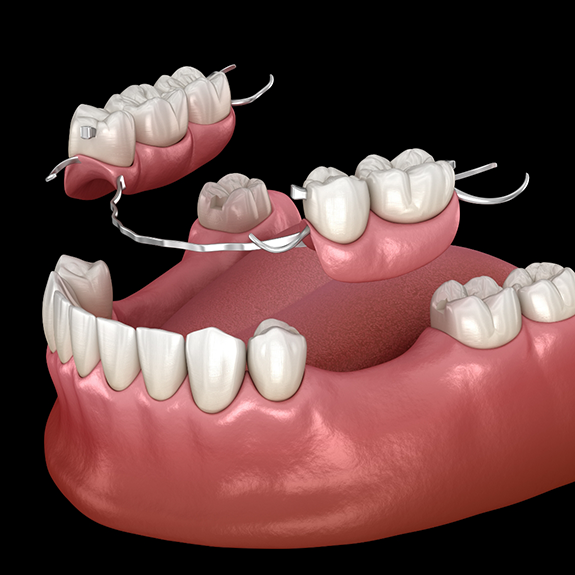 Illustration of partial denture in Reynoldsburg being placed on lower jaw