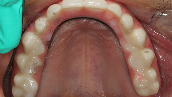 Overhead shot of teeth after treatment