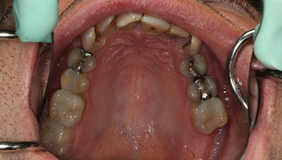 Overhead shot of teeth before treatment