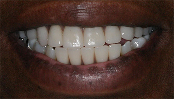 Close up of smile with teeth replaced