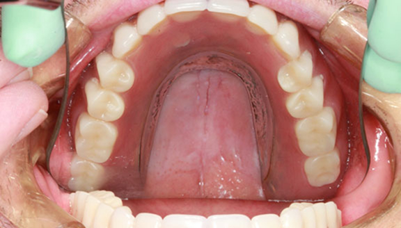 Top view of teeth after gaps have been filled