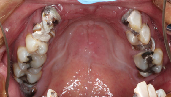 Top view of row of teeth with multiple teeth missing