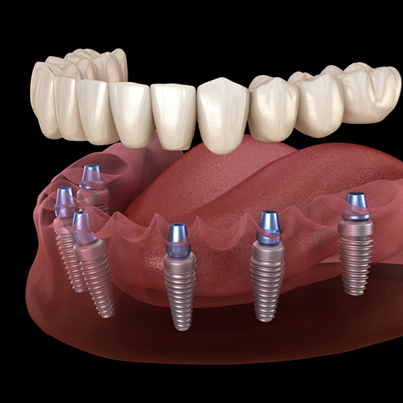 Illustration of dentures being attached to dental implants