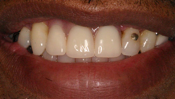 Close up of smile with front teeth replaced