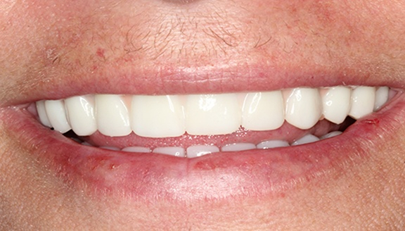 Close up of smile with replaced teeth