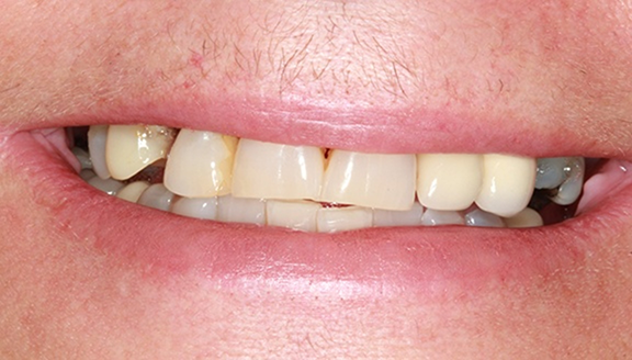 Close up of smile with damaged teeth