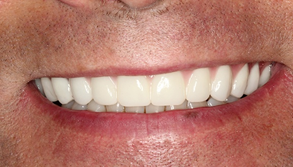 Close up of smile after treatment