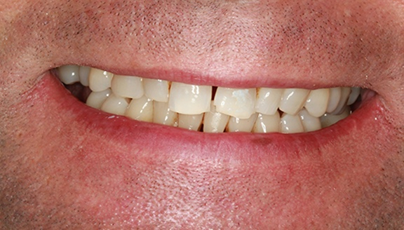 Close up of smile with damaged unevenly spaced teeth