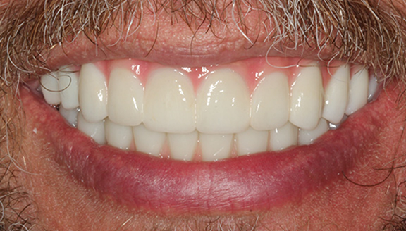 Close up of improved smile