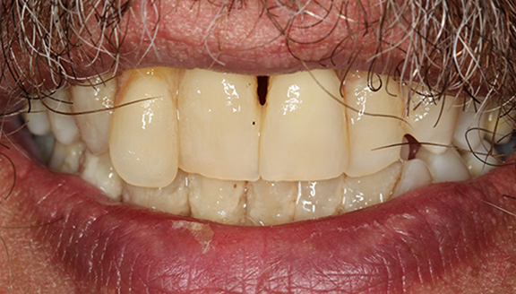 Close up of gap between front teeth