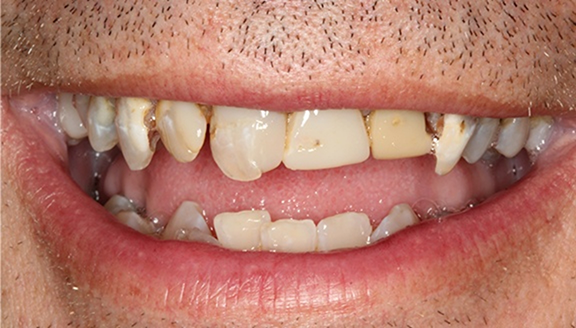 Close up of smile with many damaged teeth