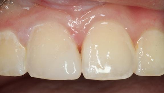 Close up of a repaired tooth