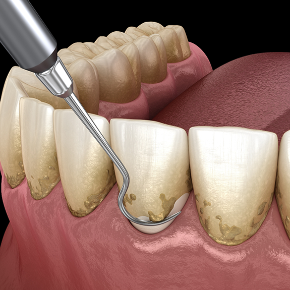 Illustration of scaling and root planing for gum disease treatment in Reynoldsburg