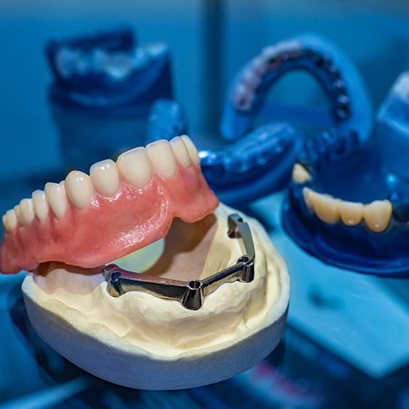 Close up of unassembled model of implant dentures in Reynoldsburg