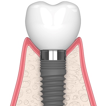 Illustration of a single dental implant in Reynoldsburg, OH