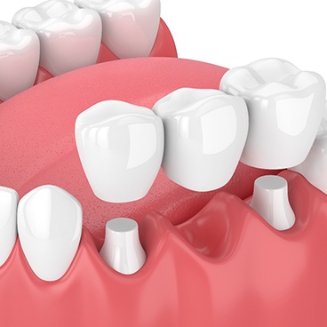 Illustration of dental bridge attached to dental implants in Reynoldsburg, OH