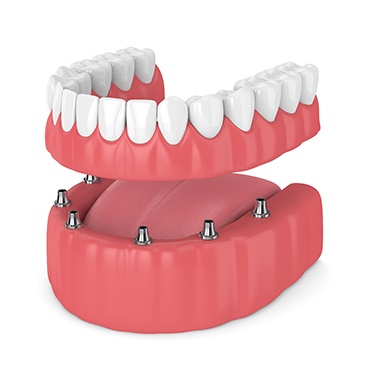 Illustration of dentures and dental implants in Reynoldsburg, OH