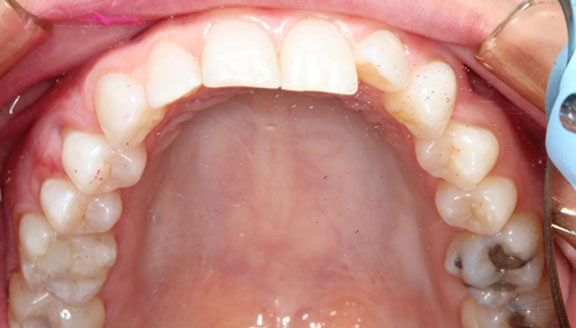 Overhead shot of uneven teeth