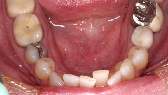 Close up of badly misaligned teeth